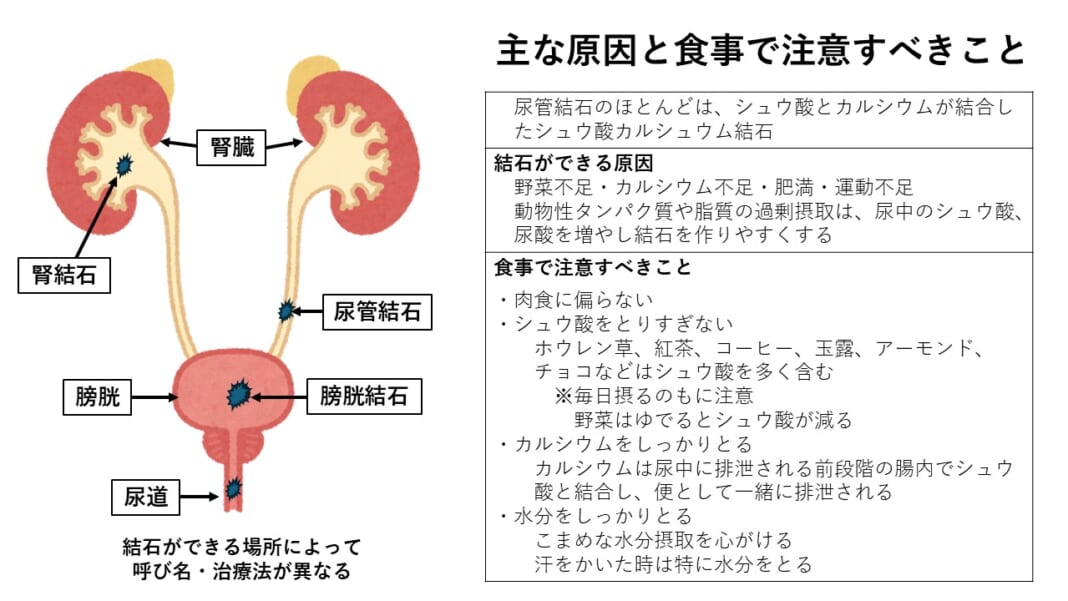 夏場は尿管結石に注意 | デジタルSunday世界日報