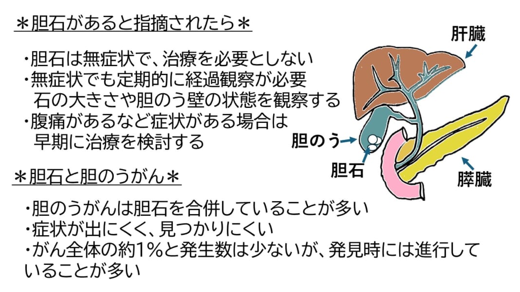 胆石と胆のうがん