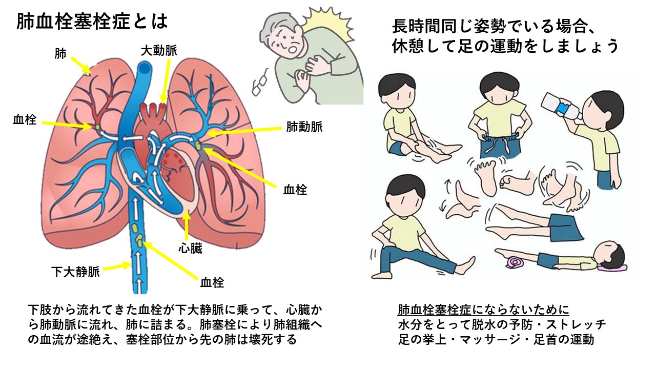 肺 塞栓 症 と は