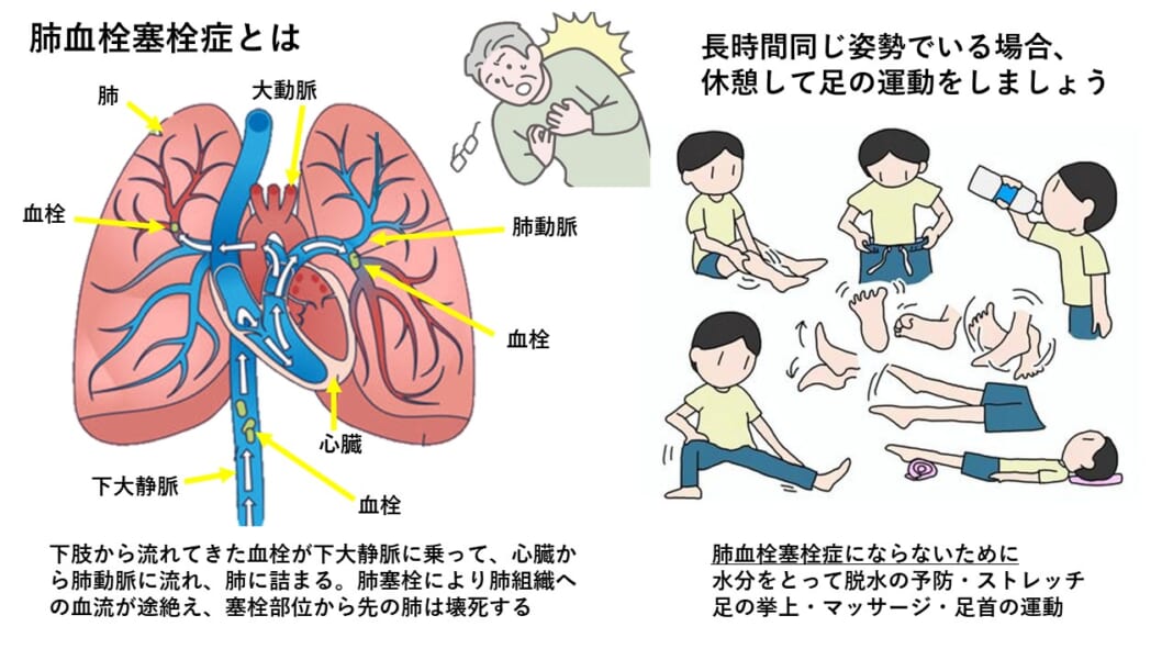 肺血栓症を予防する