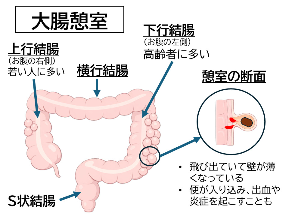 珍しくない「大腸憩室」