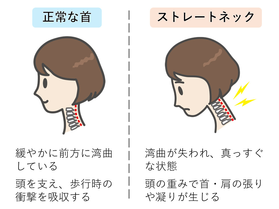 正常な首とストレートネック（スマホ首）