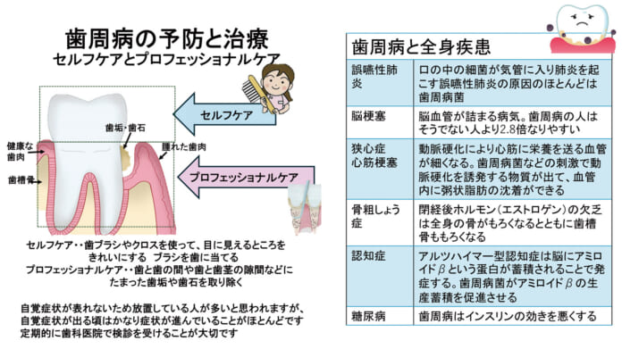 歯周病の予防と治療のイメージ図