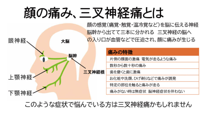 顔の痛み 三叉神経痛