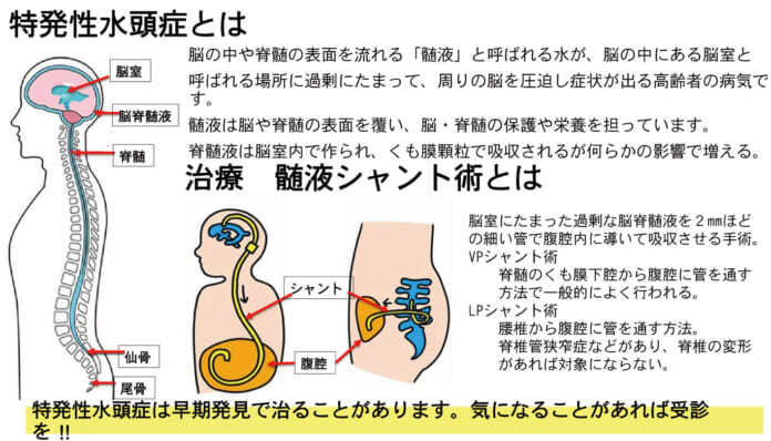 特発生水頭症