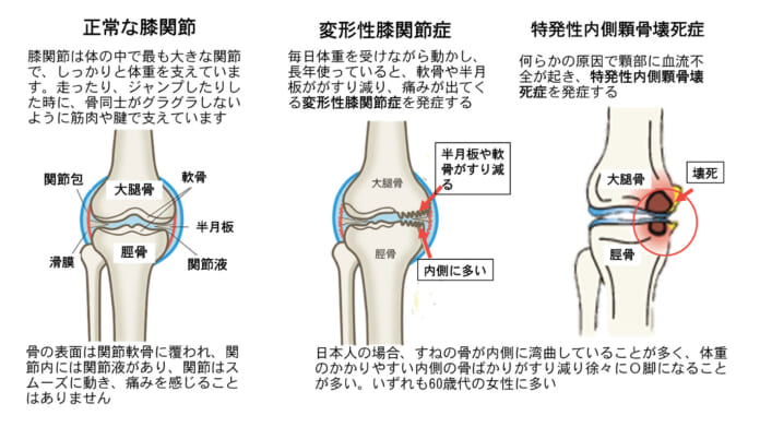 大腿骨内側顆骨壊死症のイメージ