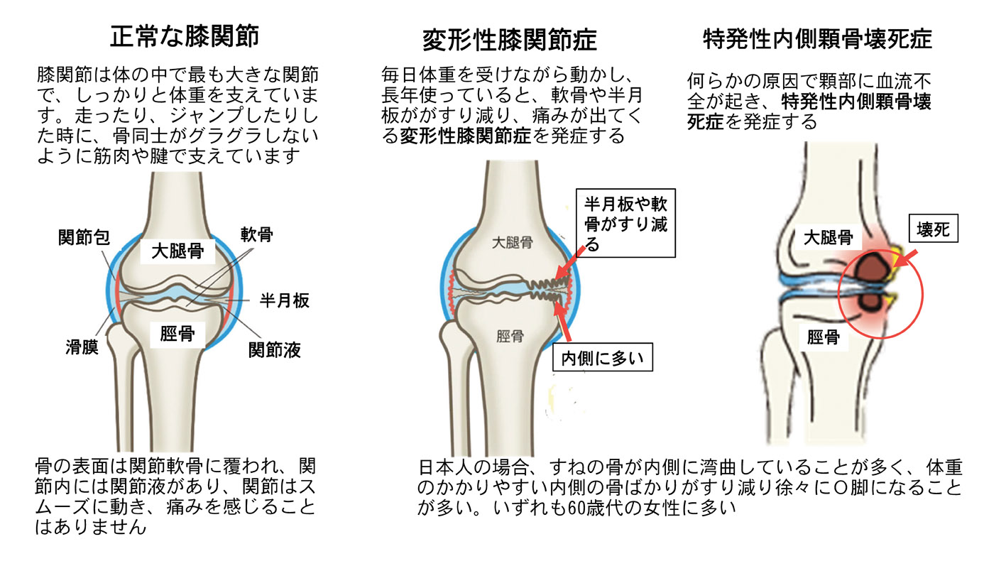 大腿 骨 内 顆 骨 壊死