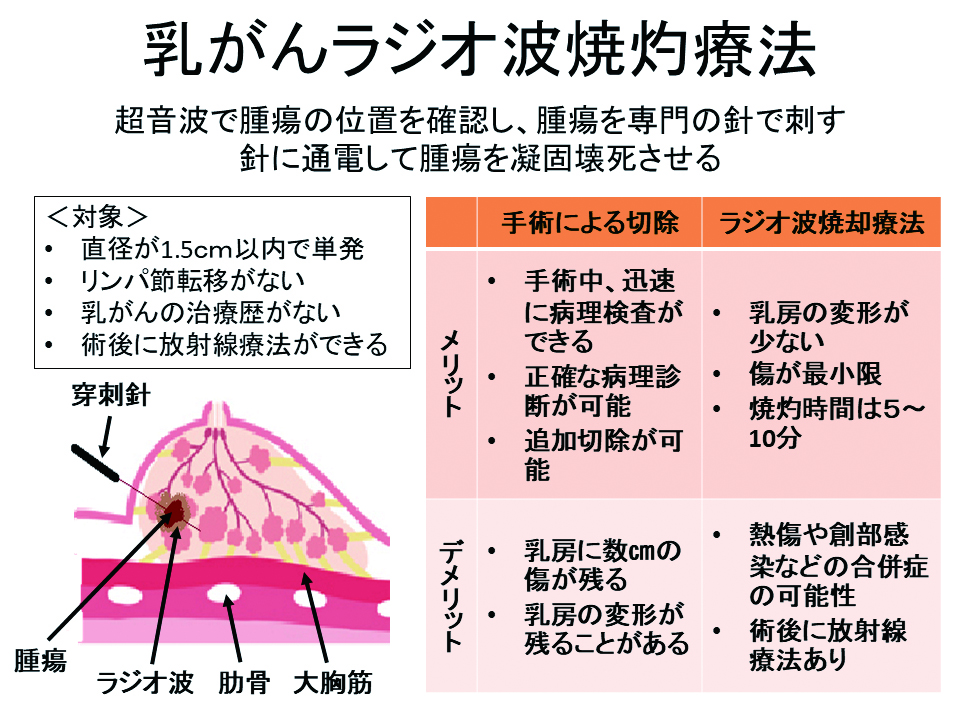 乳がんラジオ波焼灼療法